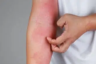 Médecine prophétique eczéma