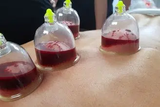 hijama médecine prophétique