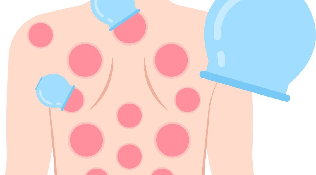 Existe-t-il des points précis pour faire la  hijama ?